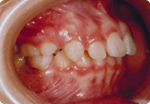 不正咬合　矯正治療開始時　右側