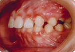 不正咬合　矯正治療開始時　左側